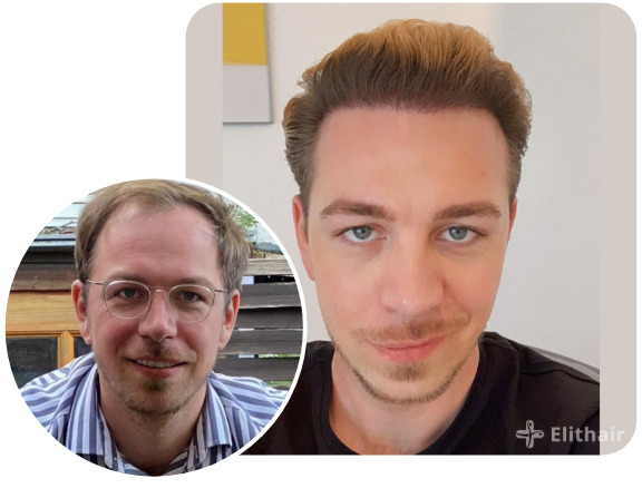 Elithair patient after a DHI hair transplant with 4850 grafts