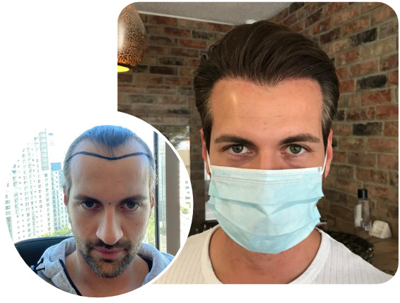An Elithair hair transplant patient after 3800 grafts with sapphire hair transplant