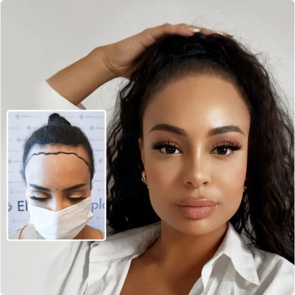 A hair transplant for women is ideal for correcting the hairline
