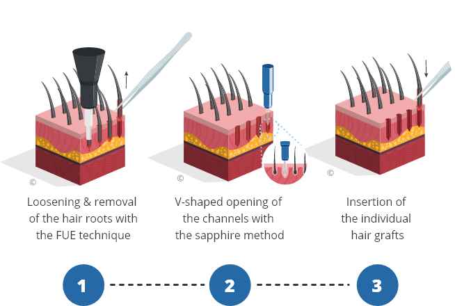 Infographic explaining the Sapphire hair transplantation procedure