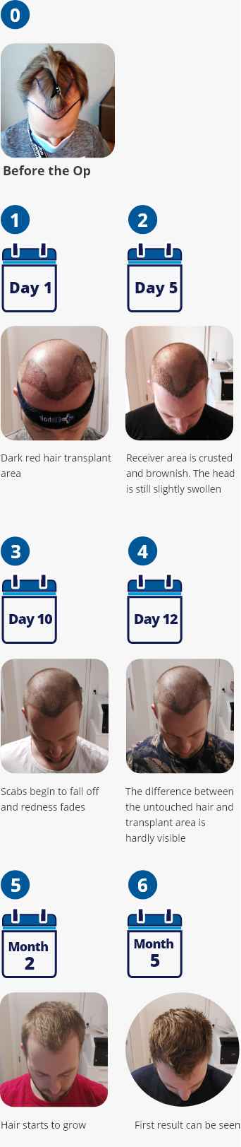 Infographic with photos showing the stages of the healing and recovery process after a hair transplant from day one to five months
