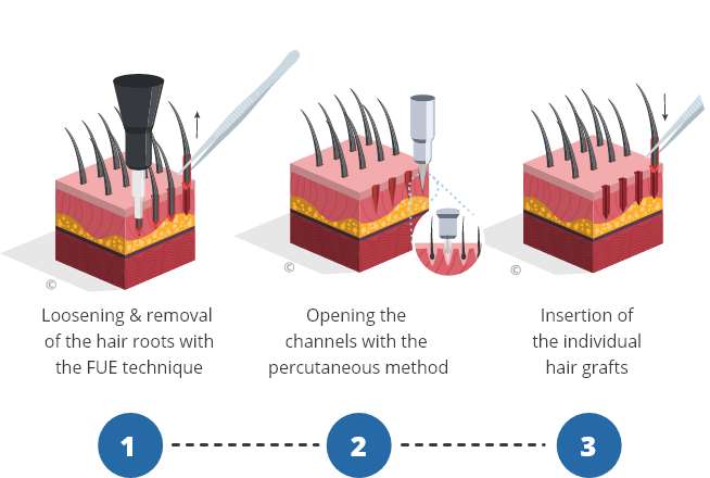 Infographic showing the process of a percutaneous hair transplant