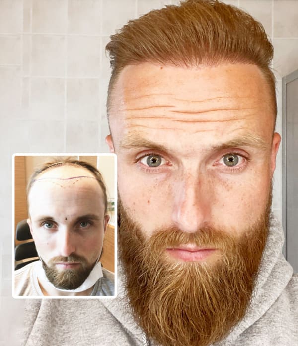 Final result in a patient after a hair transplant with 4700 grafts