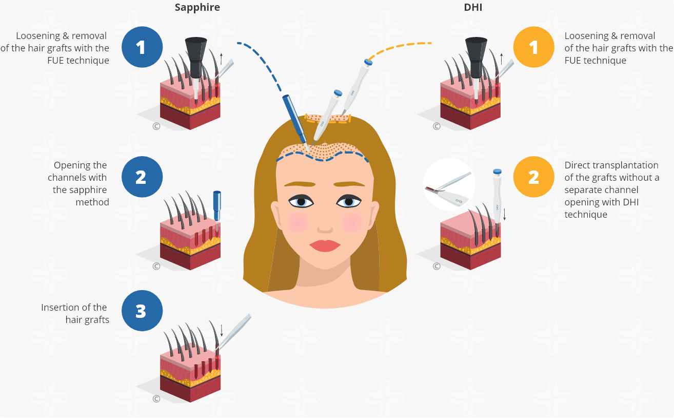 Infographic explaining the SDHI hair transplant process