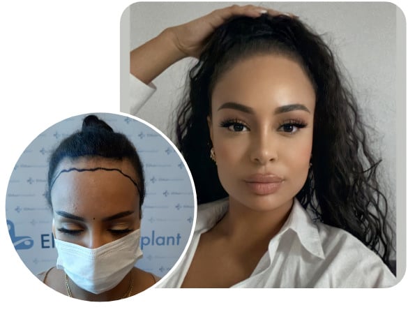 Picture of a woman with perfect results after her SDHI hair transplantation