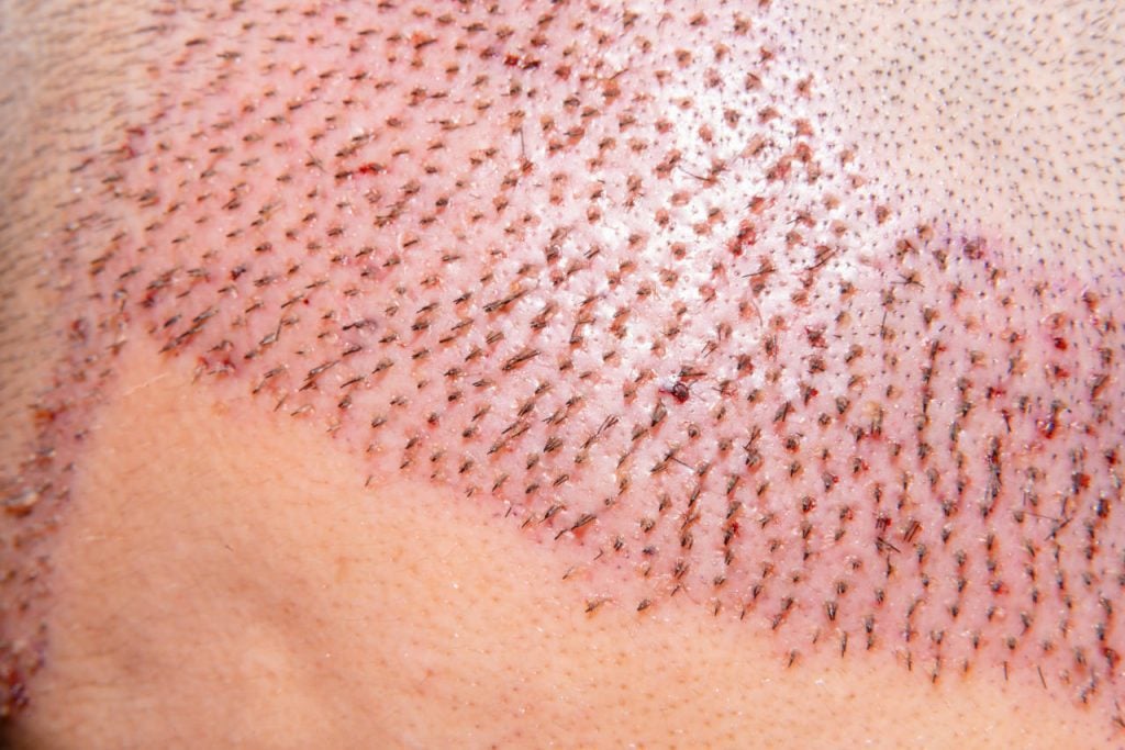 A close up image of an FUE hair transplant during the after care stage