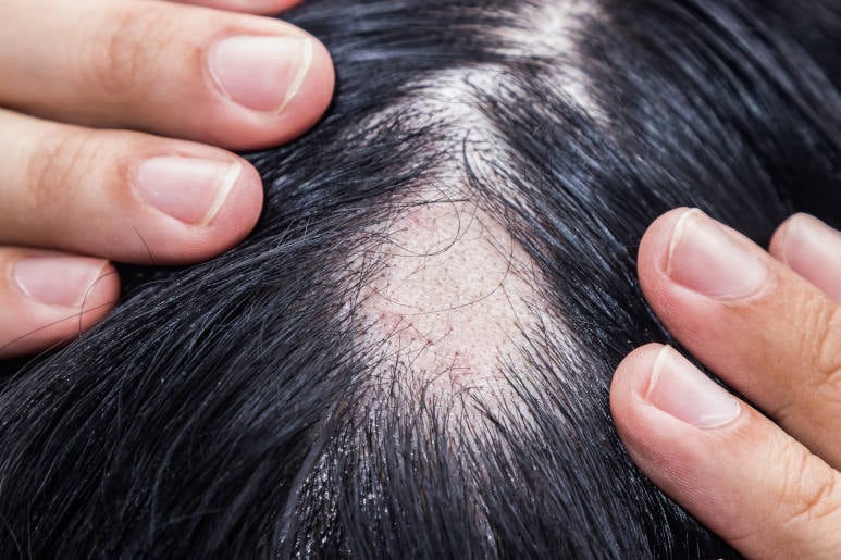 image showing a bald spot caused by an alopecia areata