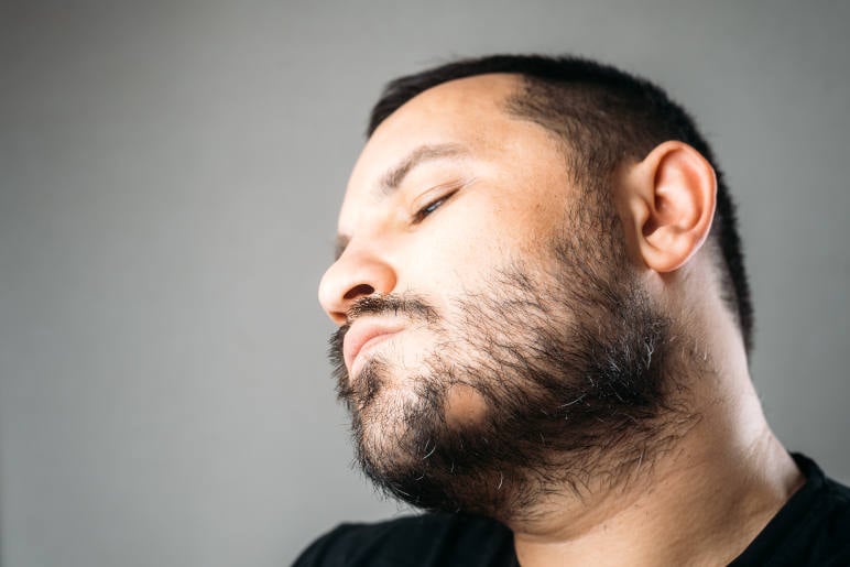 a man with alopecia areata barbae in his beard