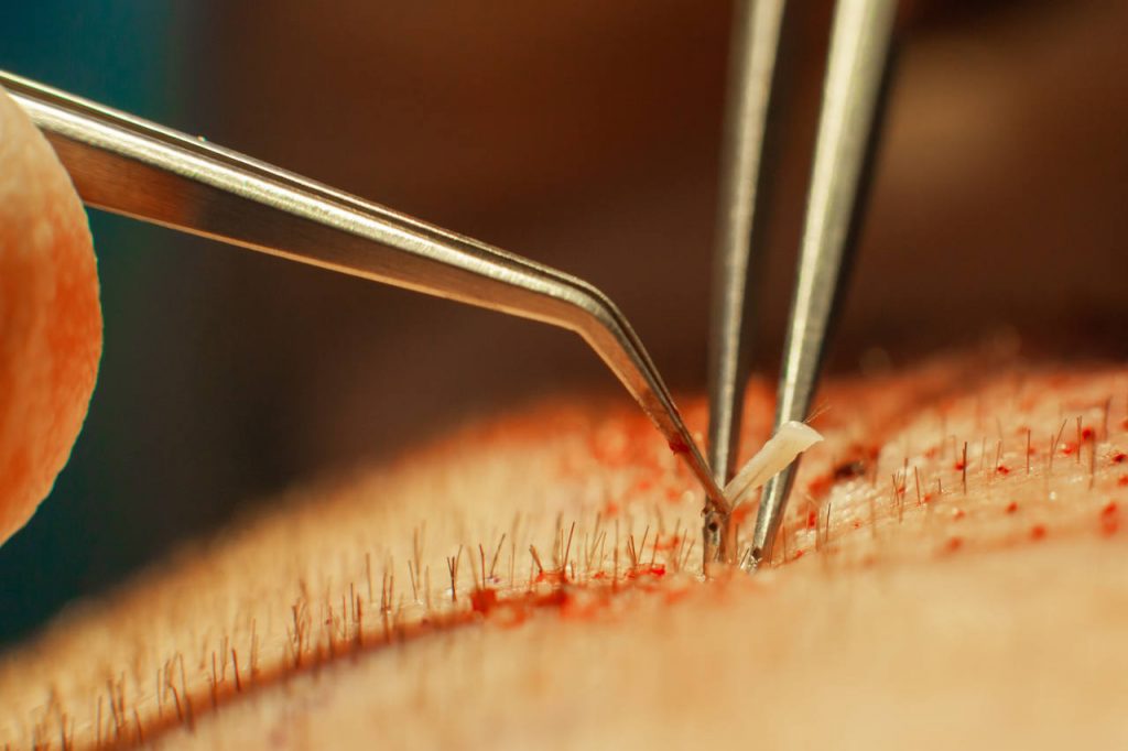 Macrophotography of an FUE hair transplant hair bulb transplanted into a hairless area