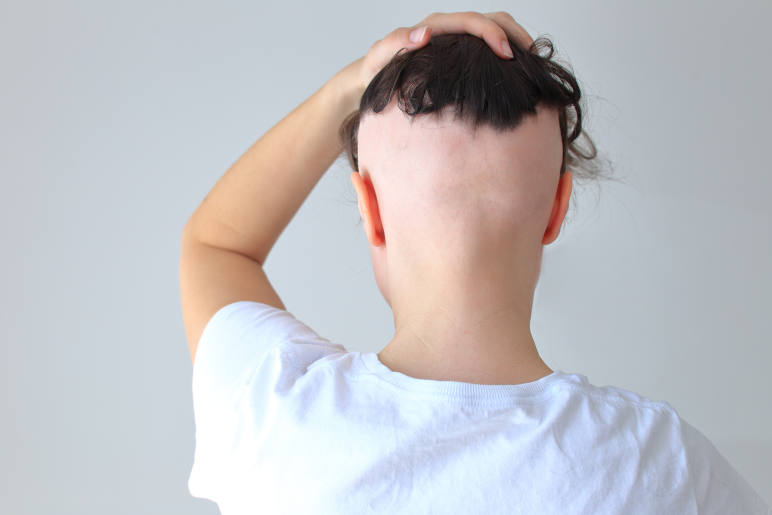 A woman with band like hair loss caused by frontal fibrsing alopecia