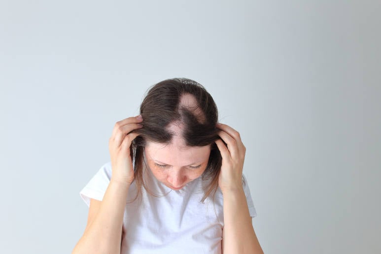 Real alopecia areata in a young girl.