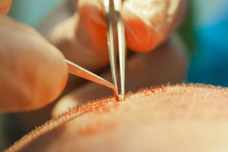 A hair surgeron inserting hair implants into a mans scalp