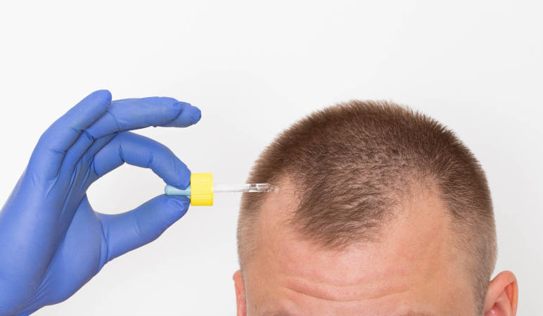 A man applying a treatment to his alopecia