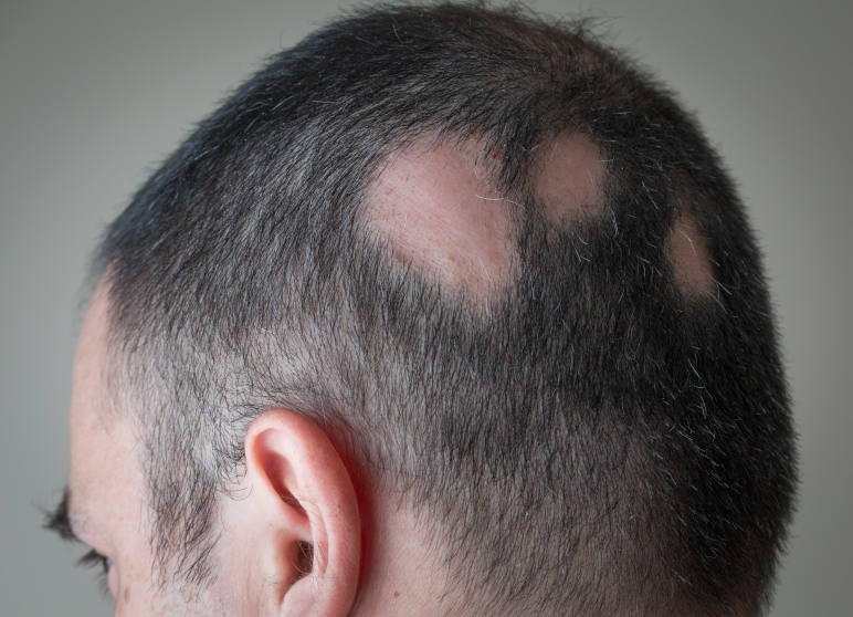 A man with alopecia areata with 3 small bald patches on his head