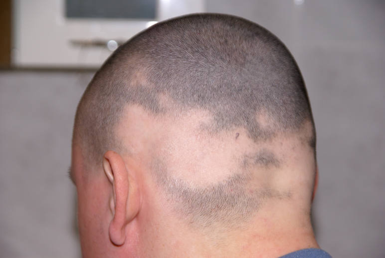 man with non scarring alopecia areata