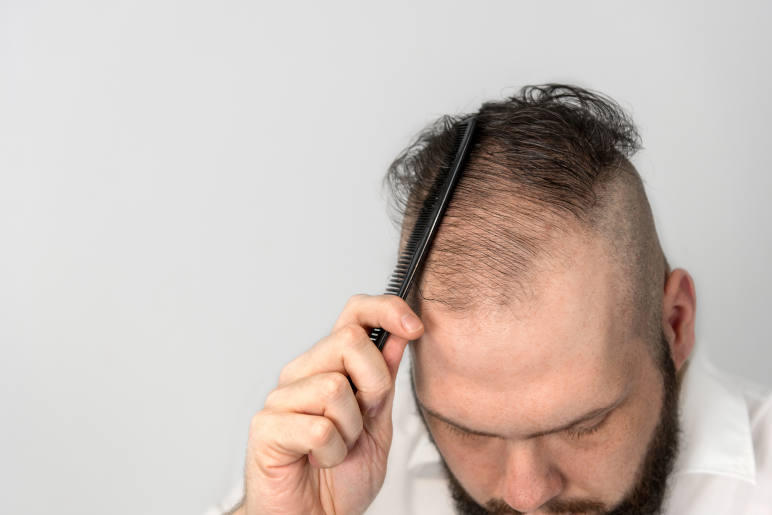 A man with thinning hair at the top of his head