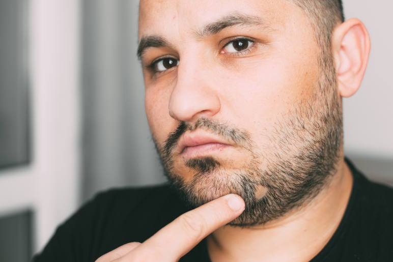 Man with alopecia area in the beard