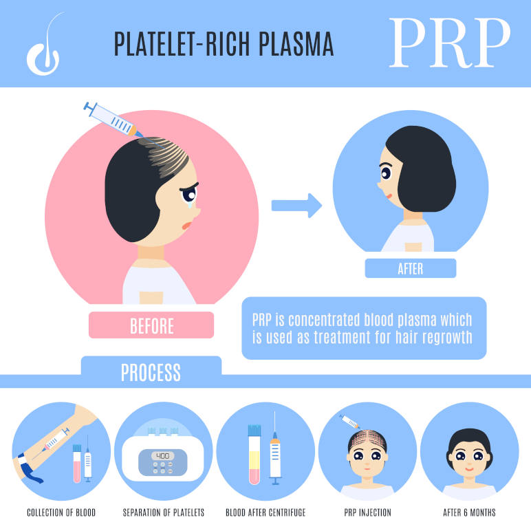 Platelet-rich plasma PRP treatment infographic of a female patient