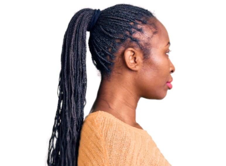 Hair loss caused by traction alopecia at the temples