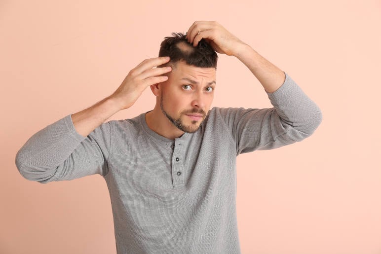 A man with a bald patch on the top of his head