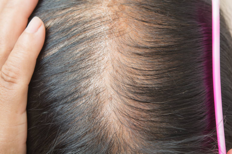 diffuse thinning in the parting of hair