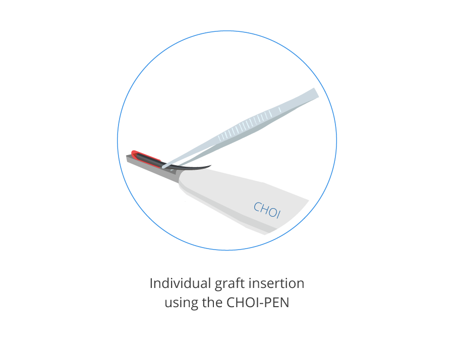 Infographic showing hair graft insertion with the CHOI pen