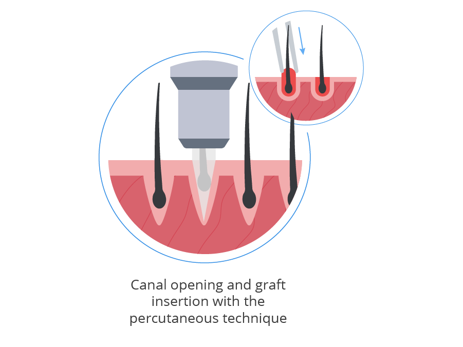 infographic showing the canal opening and graft insertion using the percutanoeus technique
