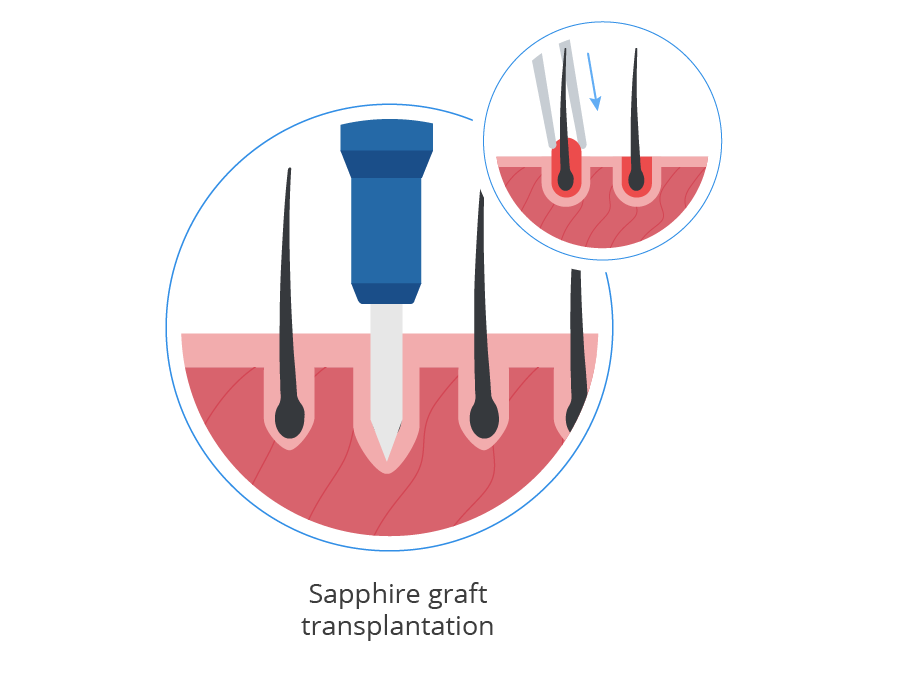 infographic showing a graft transplantation done with the sapphire technique
