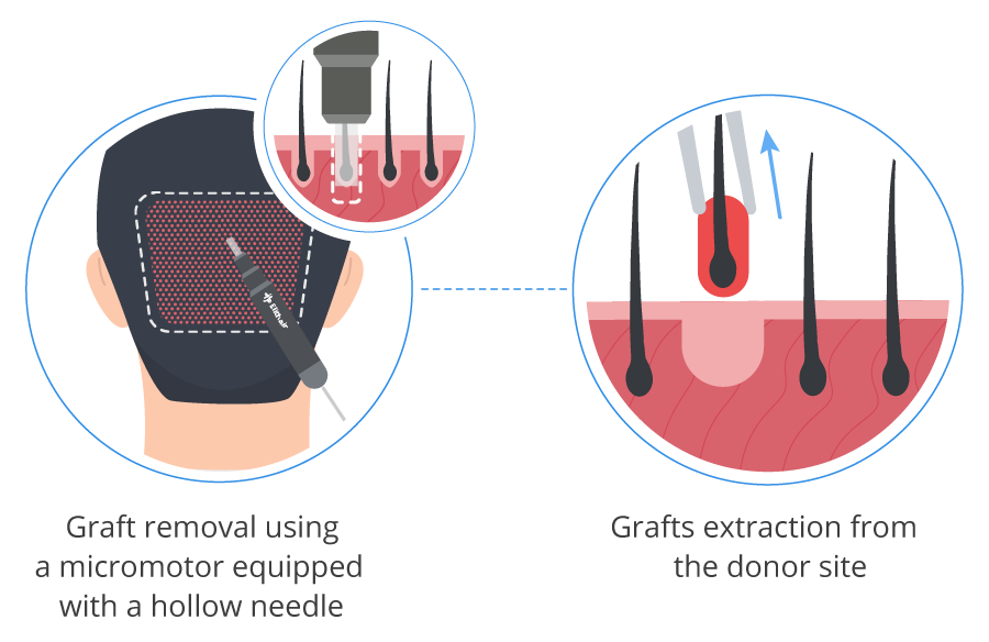 Infographic showing the hair grafts extraction from the donor area