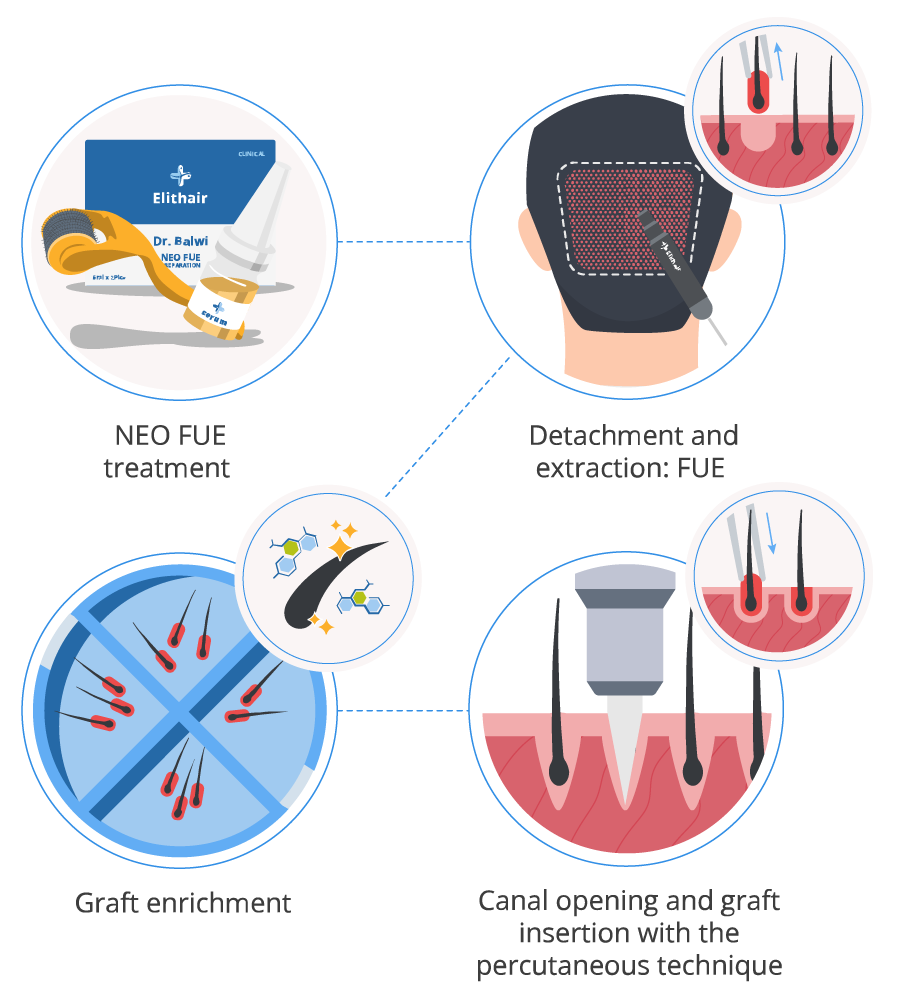 Techniques of Hair Transplant Treatment  Dr As Clinic