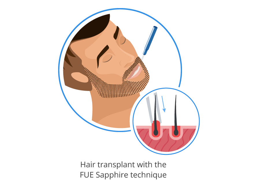 infographic showing grafts being implanted in the beard with the FUE Sapphire technique