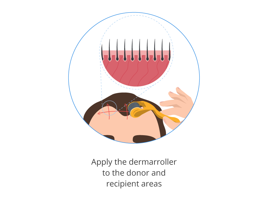 infographic showing how to use a dermarroller in the donor and recipient areas of the head