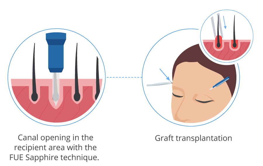 infographic showing the canal opening and the implantation of eyebrow grafts with the FUE sapphire technique.