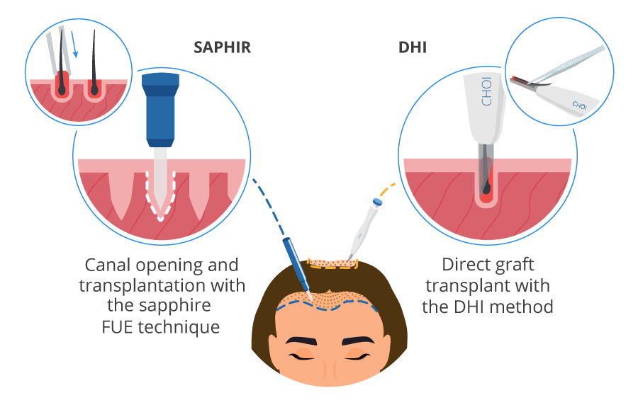 Infographic showing the female hair transplant process with the FUE Sapphire and DHI techniques