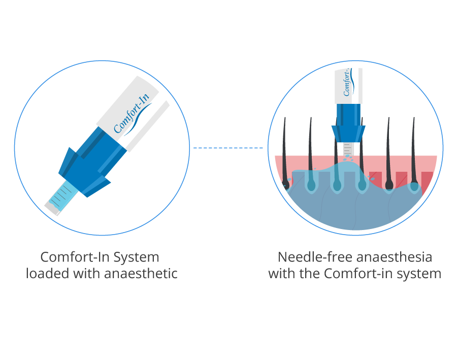 Needle Free Anesthesia in FUE Hair Transplant 2024