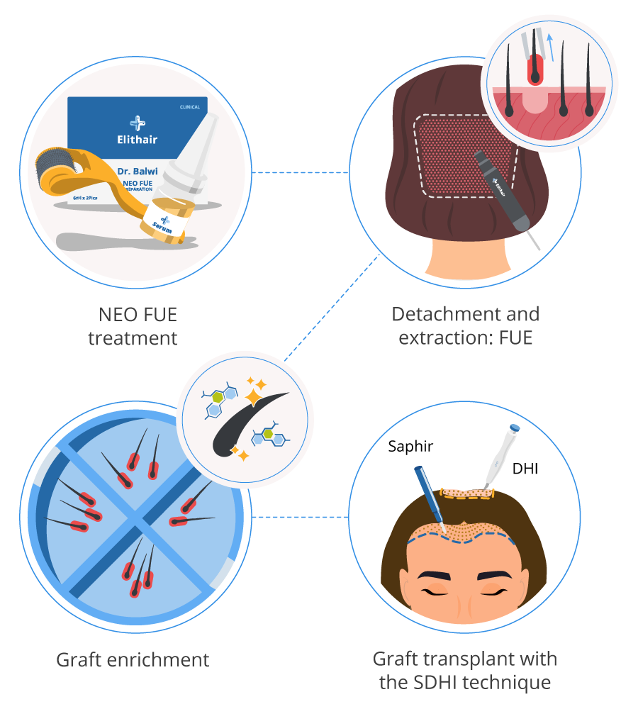 infographic showing the 4 steps of a hair transplant procedure for women