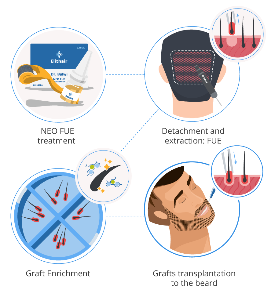 infographic showing the 4 steps of the beard transplant