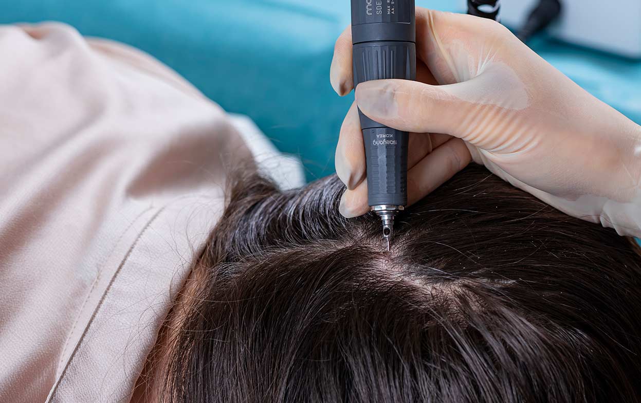 An unshaved patient during his FUE hair surgery operation at Elithair