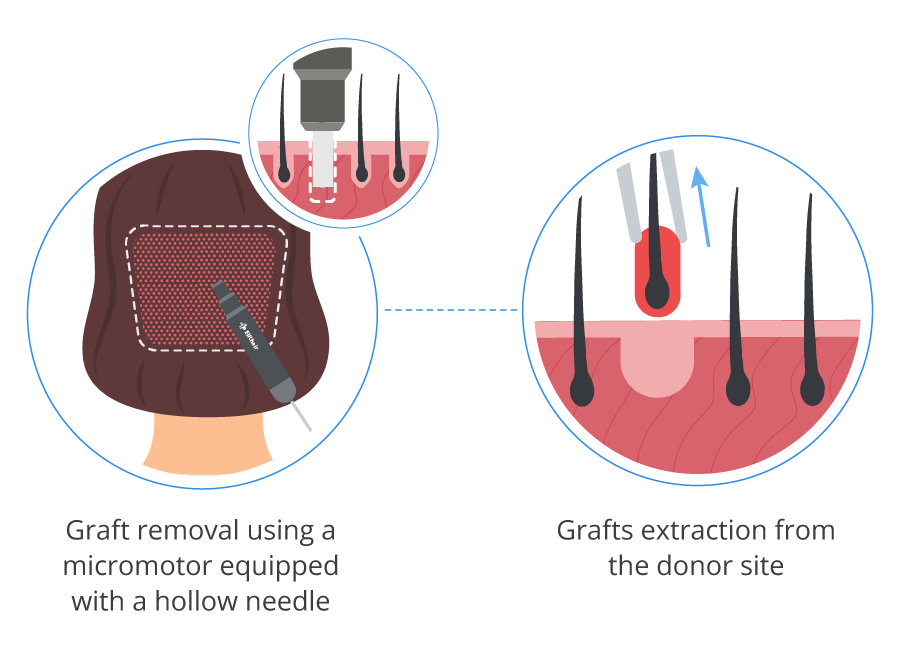 Infographic showing the hair grafts extraction from the donor area from a woman