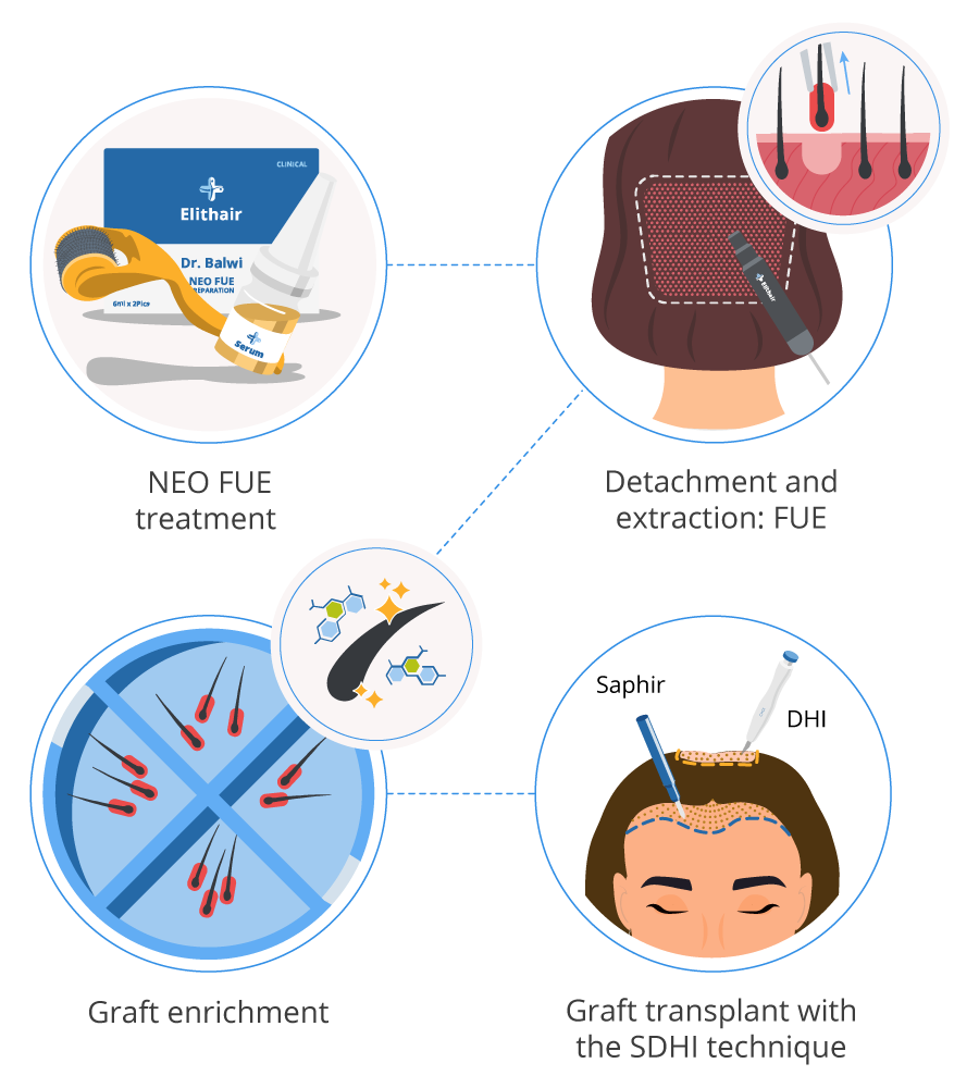 infographic showing the SDHI hair transplant procedure for women