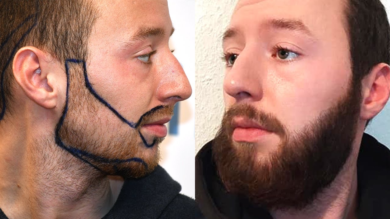 video of a beard transplant patient