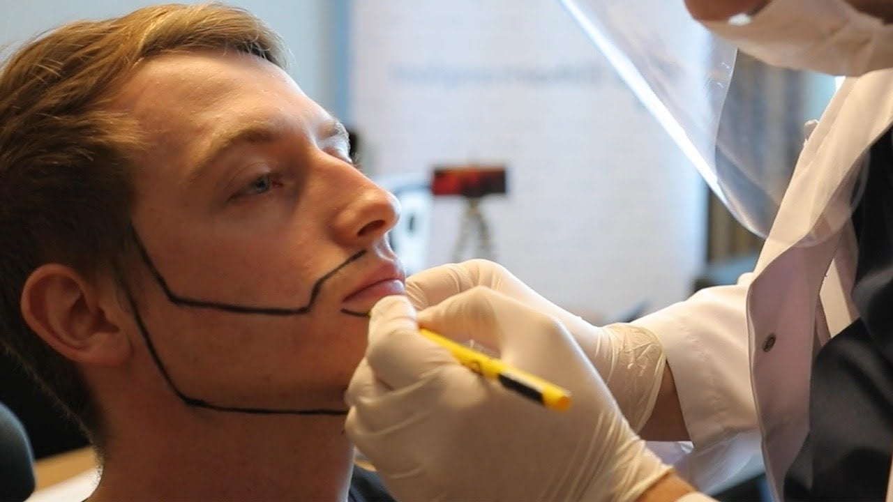 image video of a beard transplantation patient