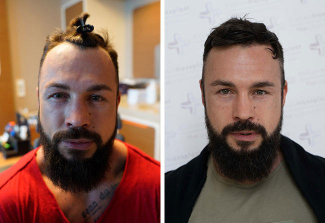image before after hair transplant fue sapphire 2200 grafts road to glory