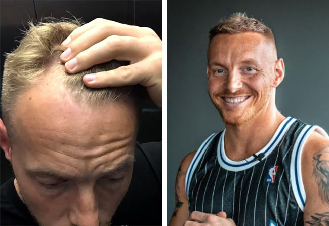 image before after hair transplant fue sapphire 3100 grafts coach stef