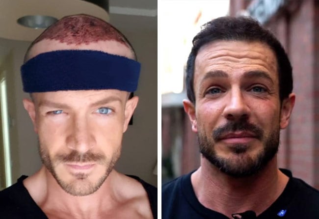 image before after hair transplant fue sapphire 3500 grafts simon teichmann