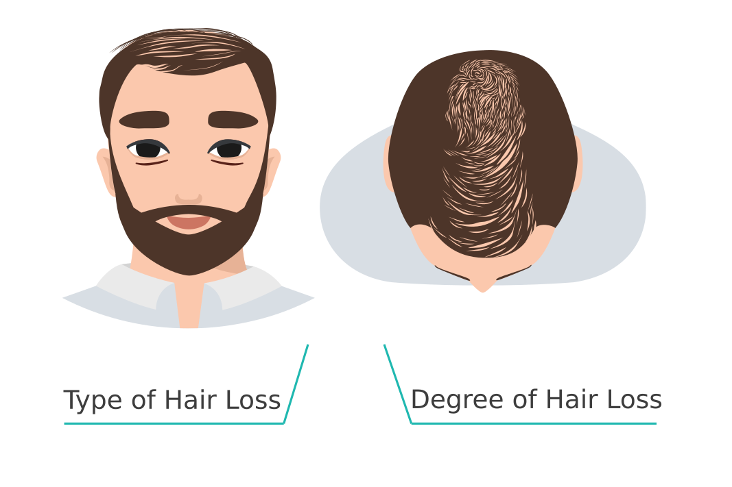 image showing the type and degree of hair loss that the Elit Skala scale can detect