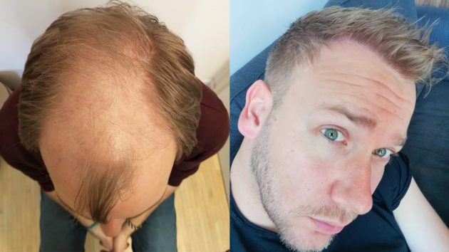 thumbnail video from a before and after result after a hair transplantation in Turkey