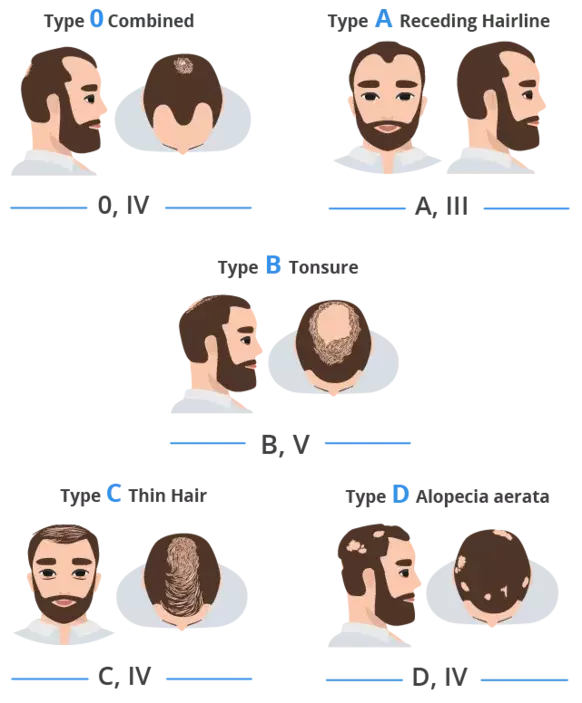 overview of the different types of hair loss according to the Elit Skala scale