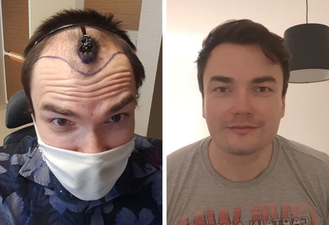 Picture Before after dhi hair transplantation 3500 grafts Chris Scholz