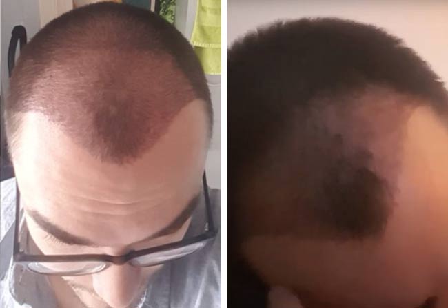 Picture Before dhi hair transplantation 3500 grafts Chris Scholz after 1 month